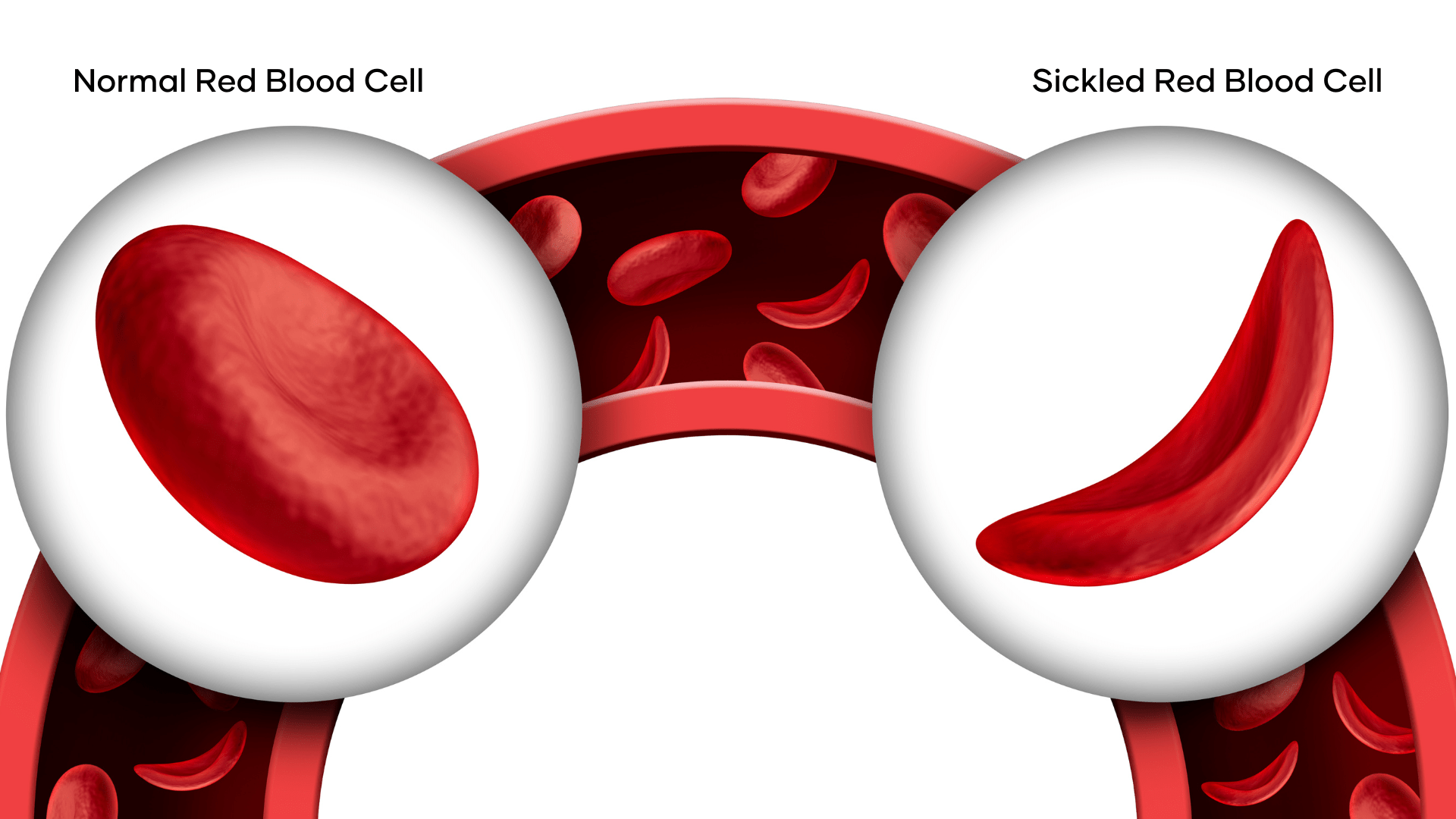Sickled Cell Vs Red Blood Cell