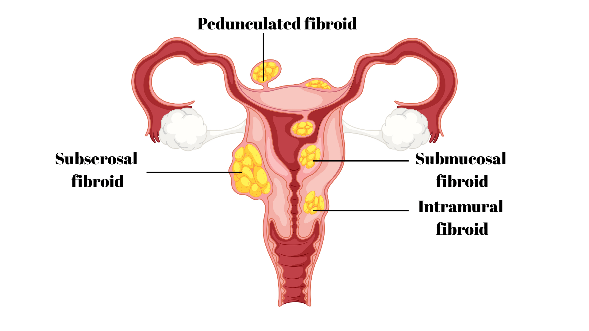location of fibroids